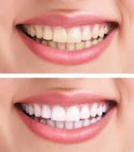 teeth whitening laser zoom enlighten