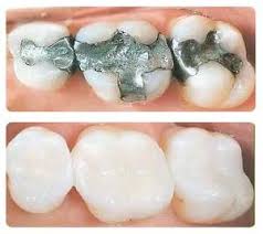 amalgam free silver free safely removed and replaced with safe BPA free and Fluoride Free Fillings