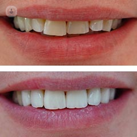 smile makeover, dental makeover, teeth makeover, cosmetic dentistry, smile makeover, mouth makeover, veneers smile makeover, cosmetic smile makeover, smile makeover dentist, best smile makeover, dentist full smile makeover, smile makeover options, one day smile makeover, cosmetic dentistry options, cosmetic dental makeover, laser teeth whitening, emax veneers, veneers