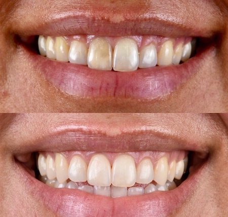 smile makeover, dental makeover, teeth makeover, cosmetic dentistry, smile makeover, mouth makeover, veneers smile makeover, cosmetic smile makeover, smile makeover dentist, best smile makeover, dentist full smile makeover, smile makeover options, one day smile makeover, cosmetic dentistry options, cosmetic dental makeover, laser teeth whitening