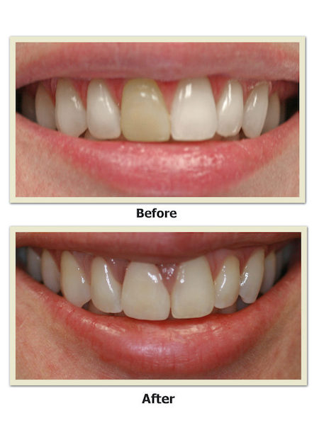 smile makeover, dental makeover, teeth makeover, cosmetic dentistry, smile makeover, mouth makeover, veneers smile makeover, cosmetic smile makeover, smile makeover dentist, best smile makeover, dentist full smile makeover, smile makeover options, one day smile makeover, cosmetic dentistry options, cosmetic dental makeover, laser teeth whitening, emax veneers, veneers
