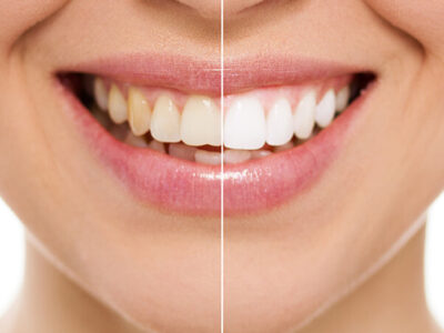 advantages-teeth-whitening advantages of teeth whitening